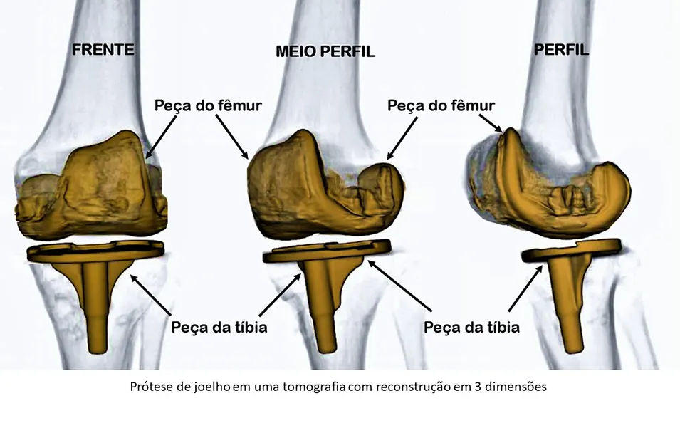 Prótese de joelho em tomografia reconstruída em 3D - Imov BSB