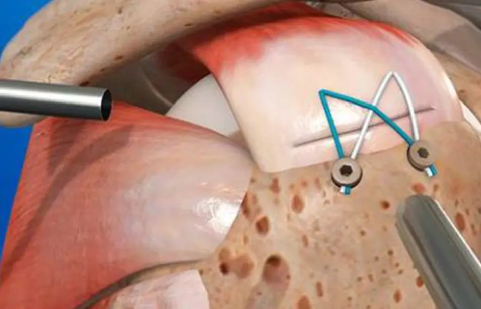Cirurgia para Reparo do Manguito Rotador
